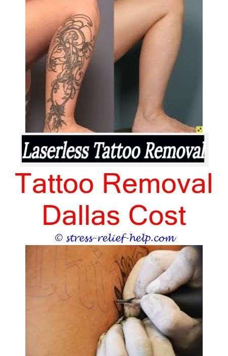 Remove tattoo yourself.How good does laser tattoo removal ...