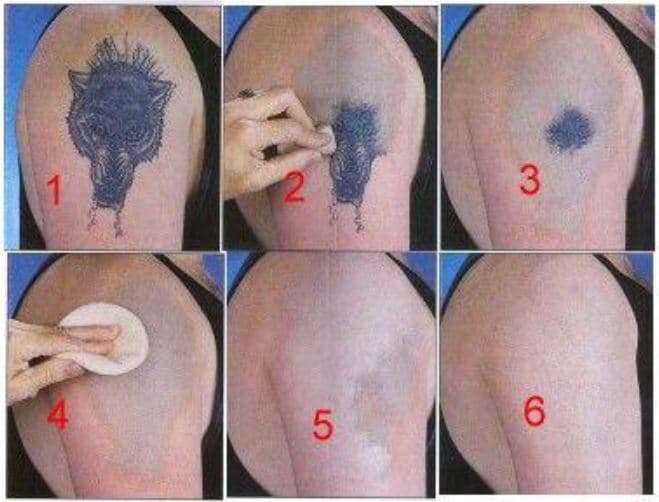 Remove Your Tattoo Naturally