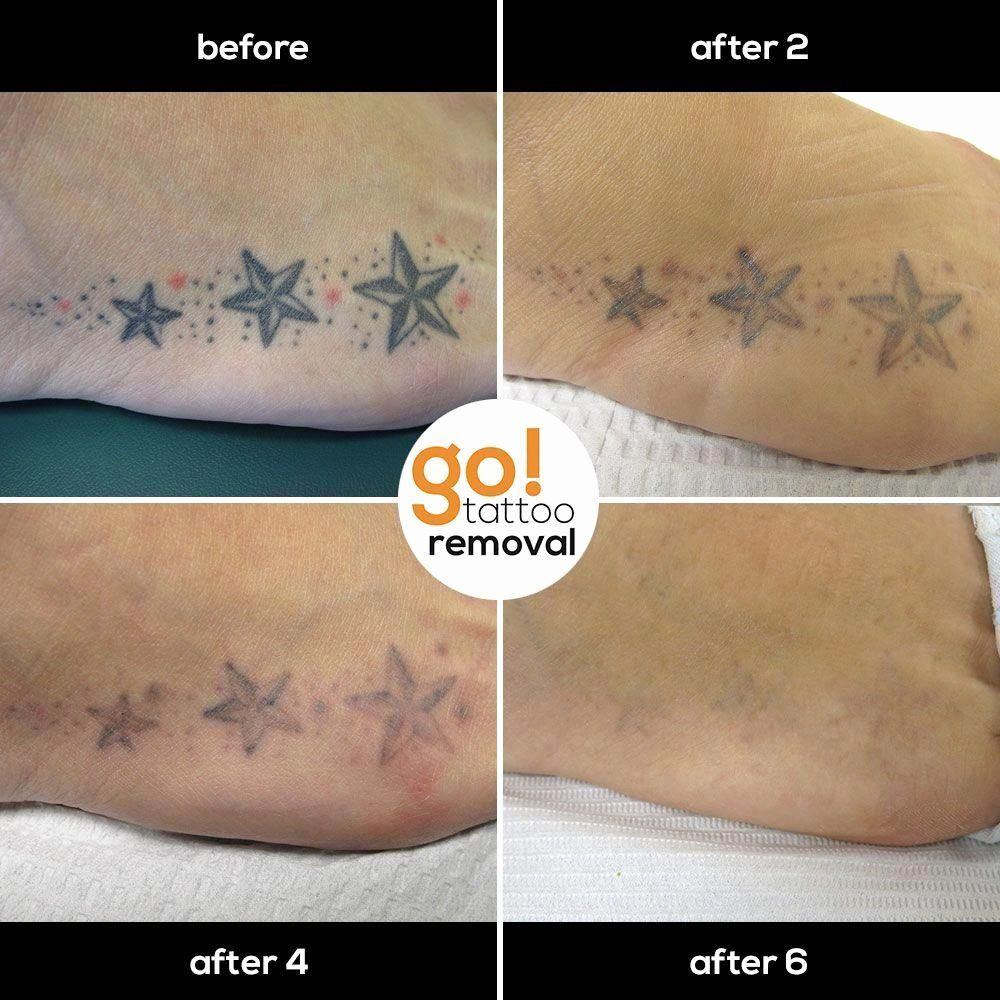 Salabrasion Tattoo Removal before and after Awesome How to Safely A ...