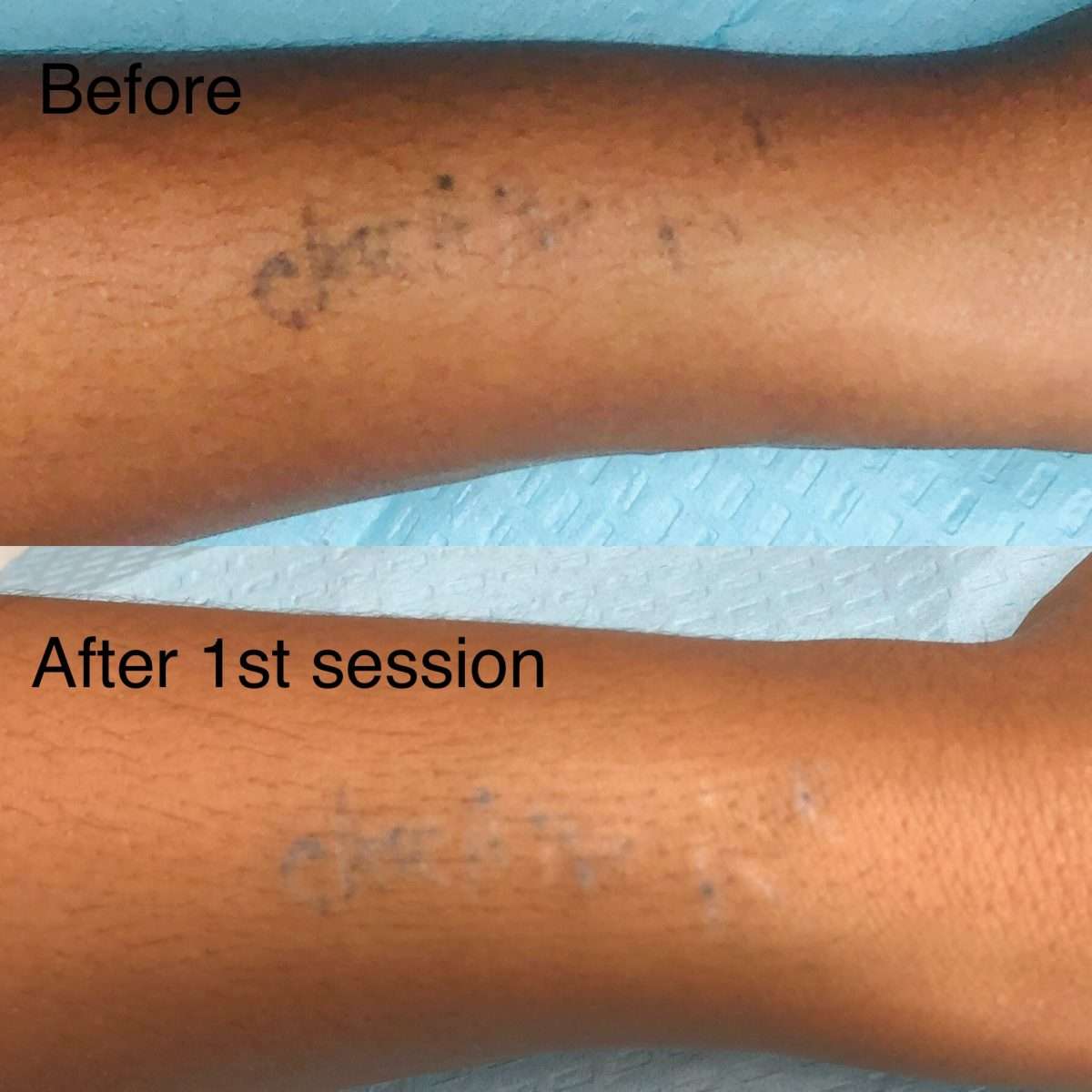 Saline Tattoo Removal is a Game Changer for Brown Skin