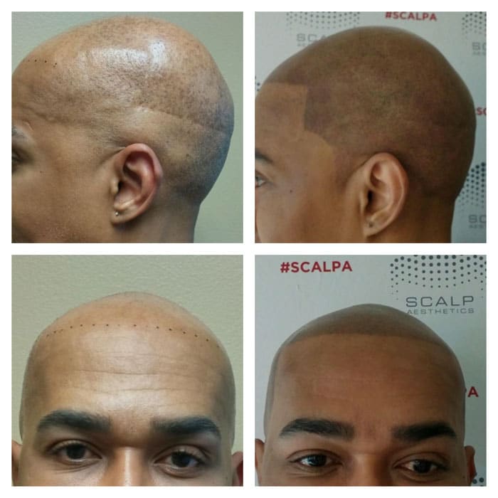 Scalp Micropigmentation, Scalp Tattoo and Hair Tattoo at Scalp ...