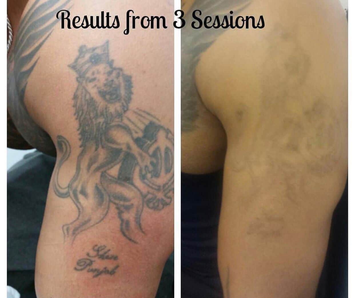 Scar From Tattoo Removal : 7 Tips After Laser Tattoo Removal Treatment ...