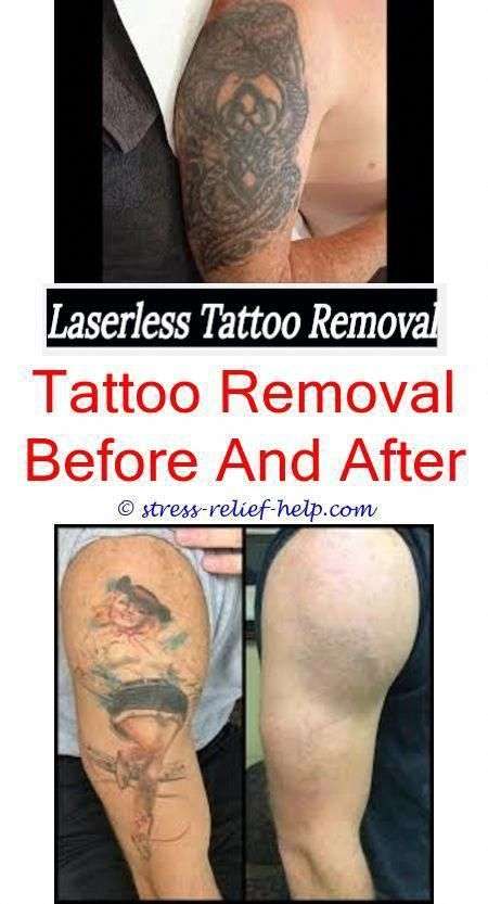 Scars After Laser Tattoo Removal