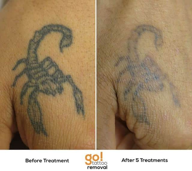 Several variables factor into how successful tattoo removal will be and ...