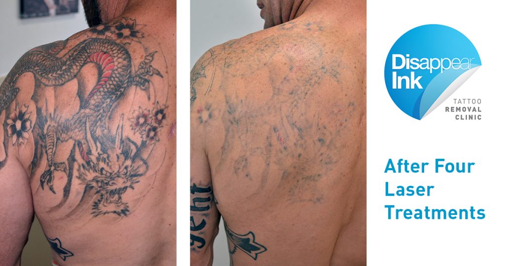 Skin After Laser Tattoo Removal / Duolite Q