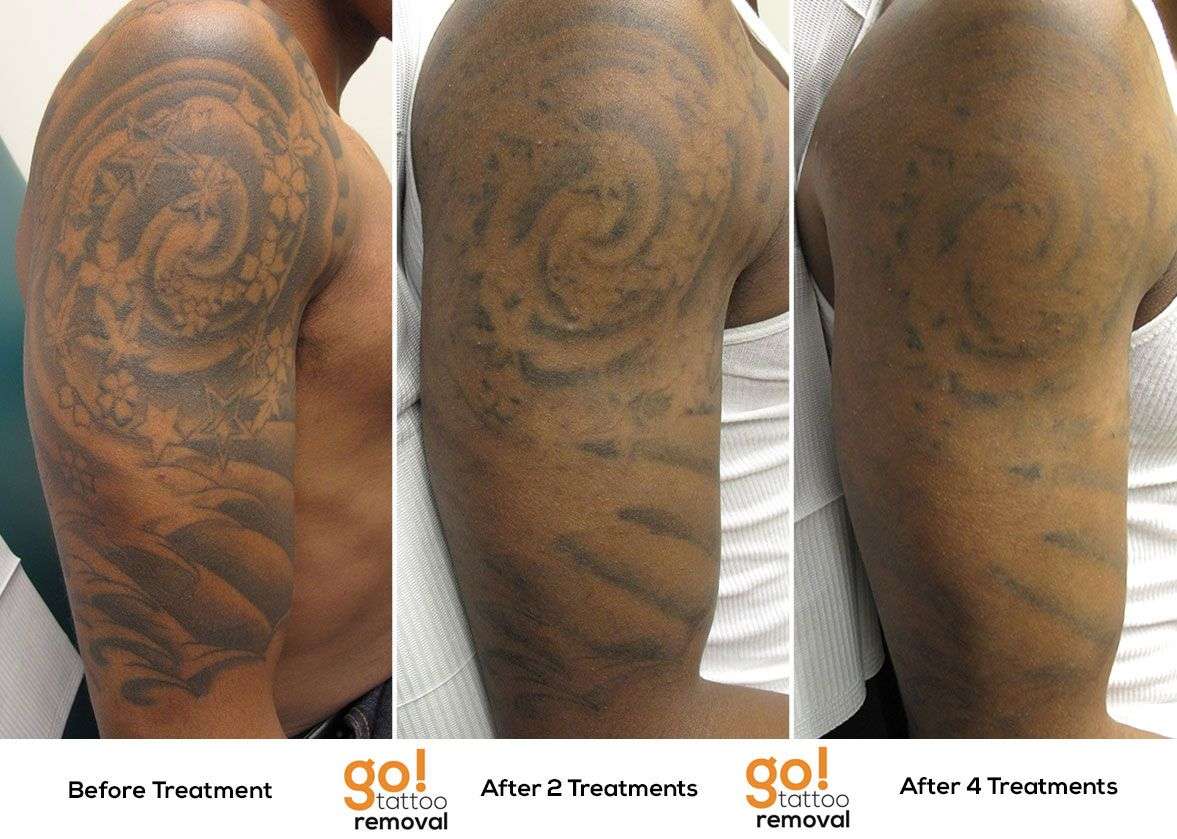 Sleeve Tattoo Removal Before And After