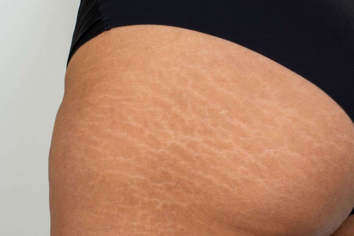 Stretch Mark Tattoo Camouflage Training / About