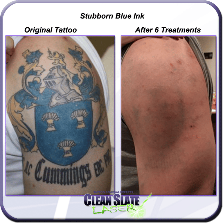 Stubborn Blue Ink?  Clean Slate Laser Tattoo Removal