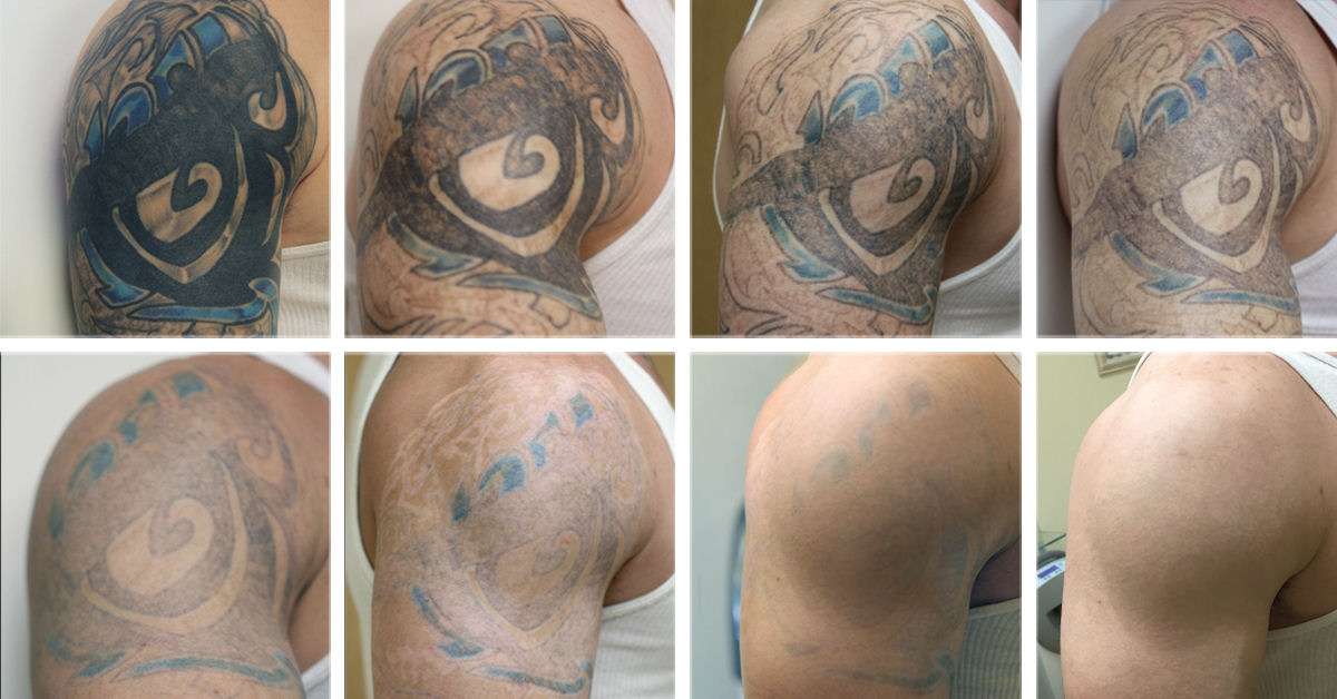Sugar Land Laser Tattoo Removal Prices In Houston, TX
