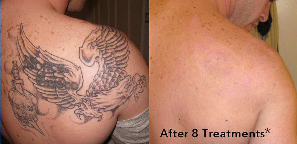 Tampa Tattoo Removal services