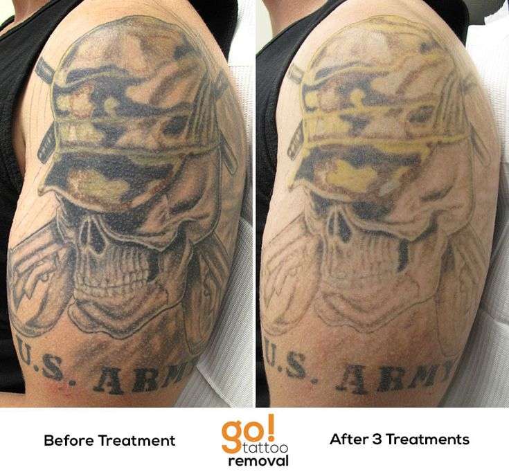 Tattoo Before And After Peeling