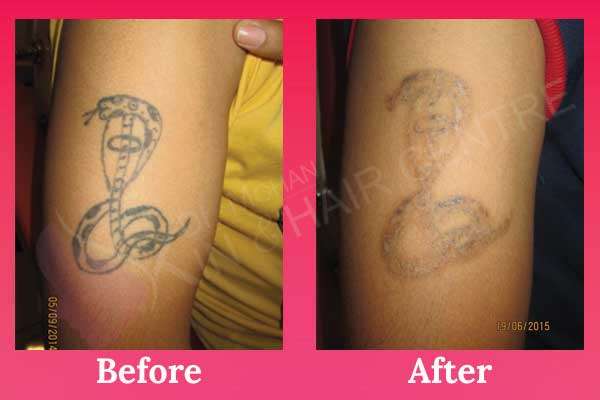 Tattoo &  Birthmark Removal
