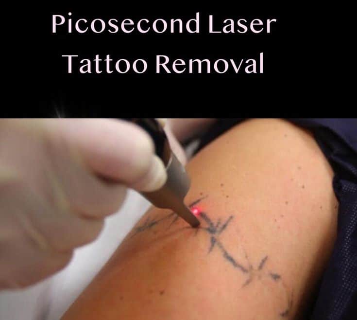 tattoo can be removed completely