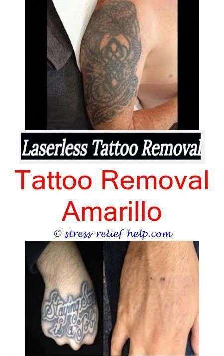 tattoo goo can laser hair removal affect tattoo