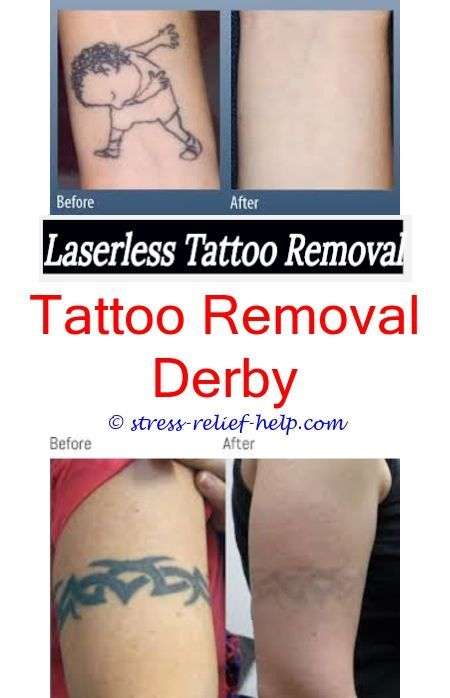 Tattoo Laser Removal Cost Near Me