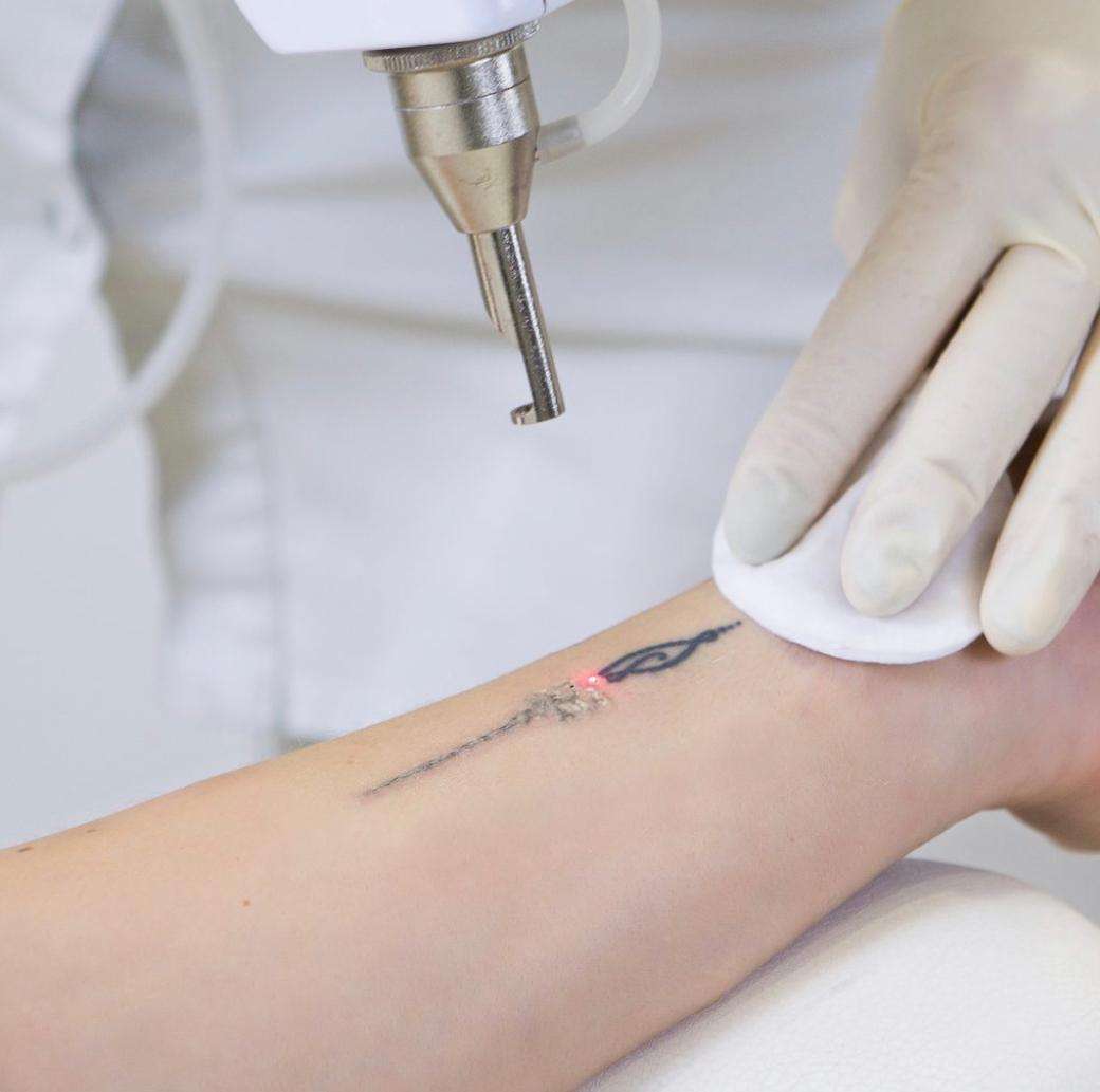 Tattoo: Laser Tattoo Removal (Per Course)  Tatu Society