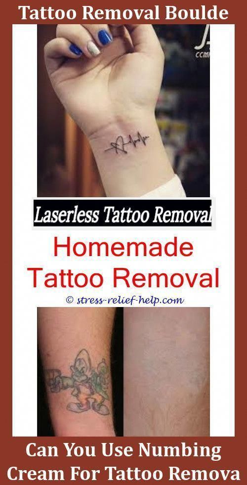 Tattoo Printer How To Remove Excess Tattoo Ink From Skin,laser tattoo ...