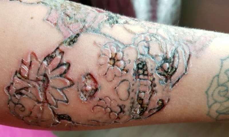 Tattoo Removal 101: The Definitive Guide to all Tattoo ...