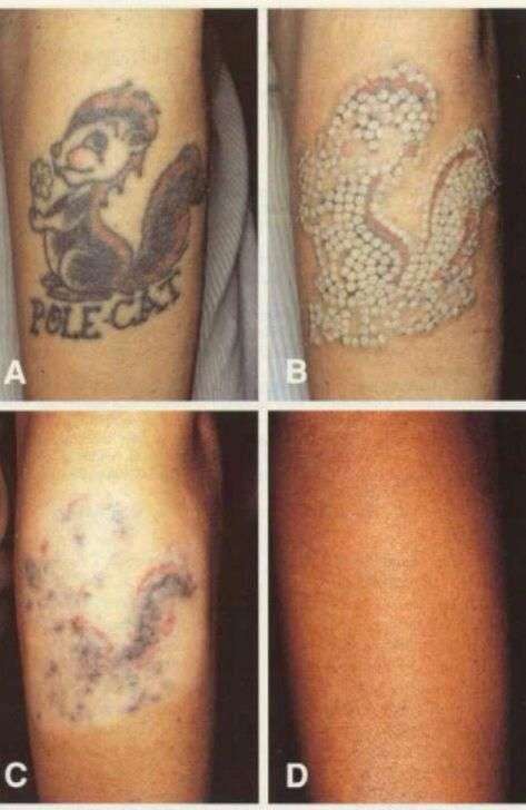 TATTOO REMOVAL $50. Do you Have tattoos that you would ...