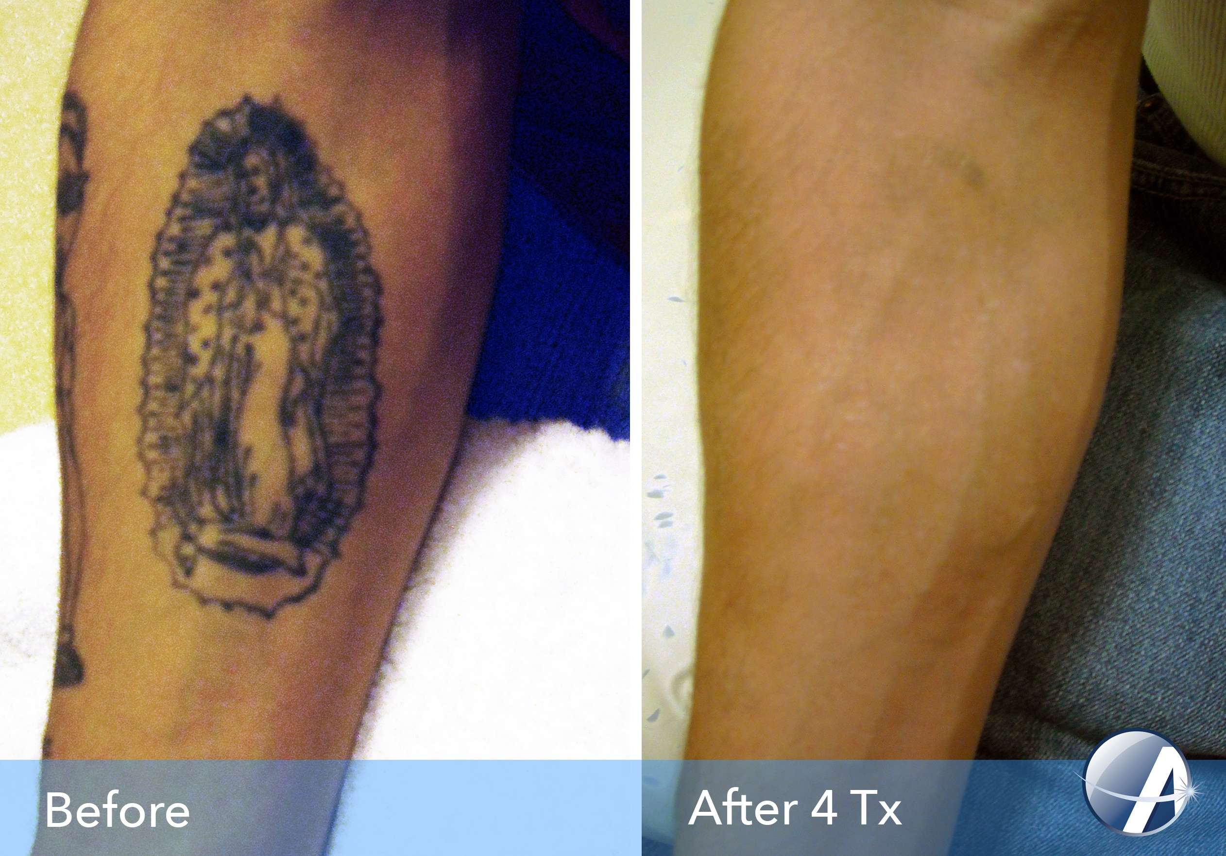 Tattoo Removal Before &  After Photos from Astanza