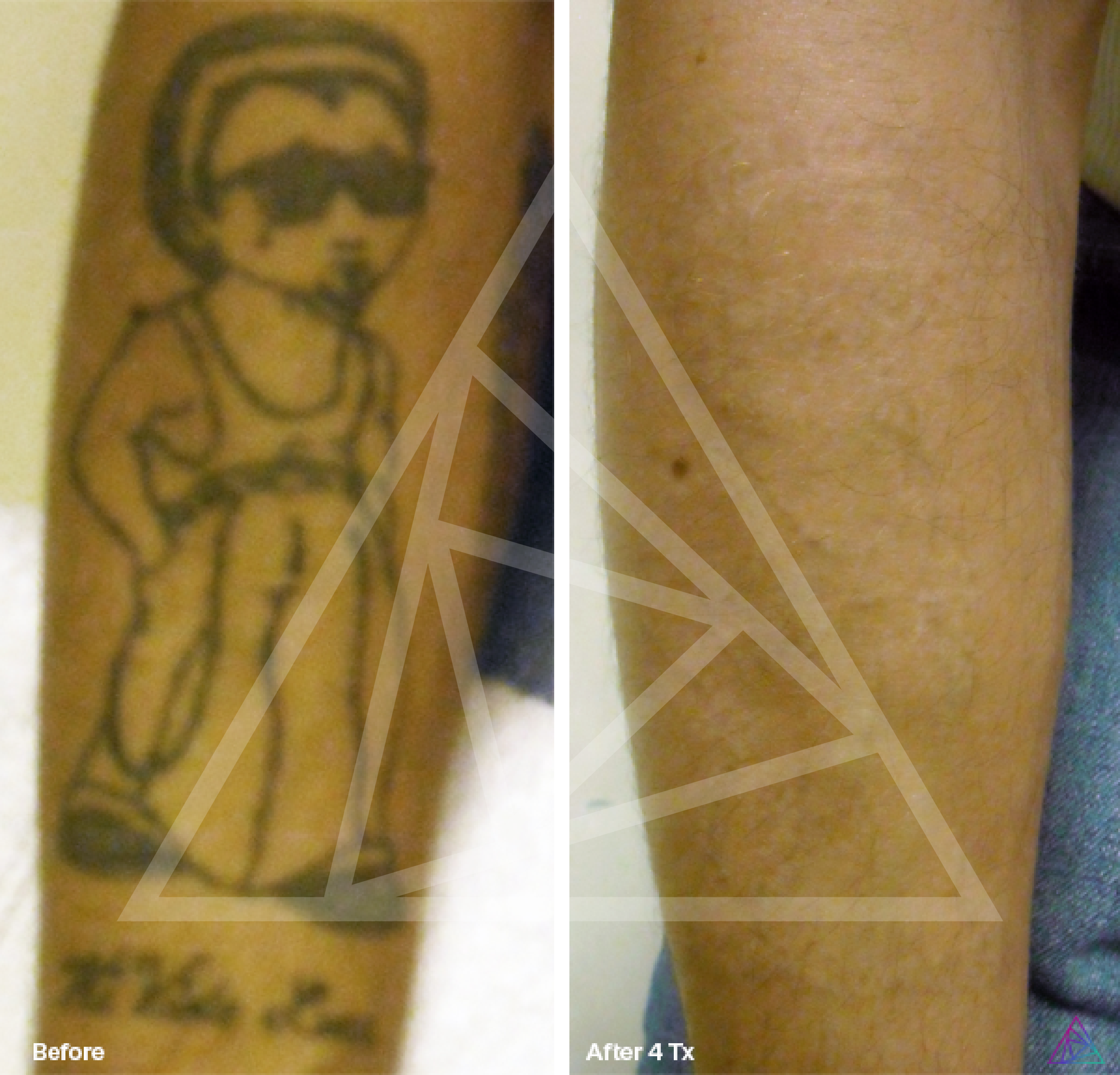 Tattoo Removal Before &  After Photos, Tattoo Removal Patient Results