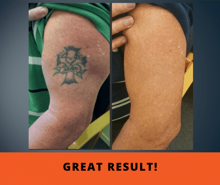 Tattoo Removal Before and After Gallery
