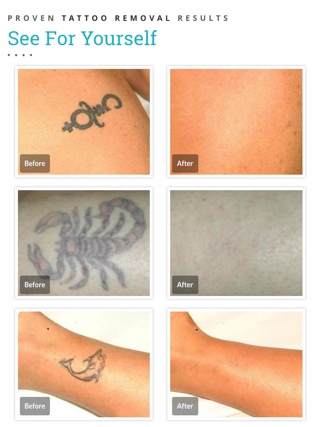 Tattoo removal before and after photos from Fresh Start ...