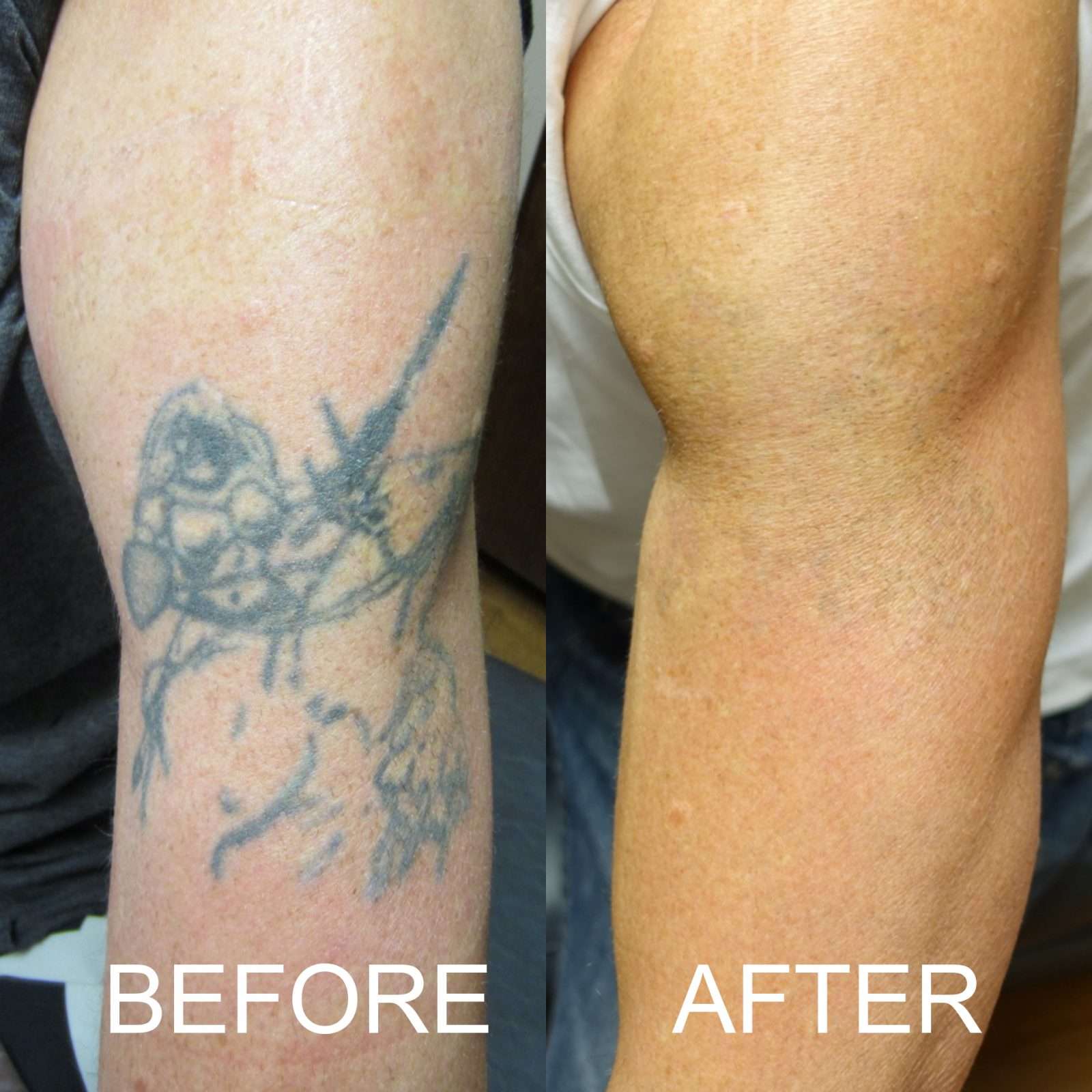 Tattoo Removal: Before/After Before and After Photos