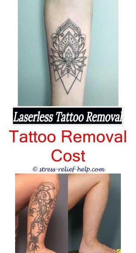tattoo removal cost can i remove tattoos