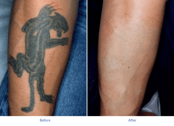 Tattoo Removal Cost