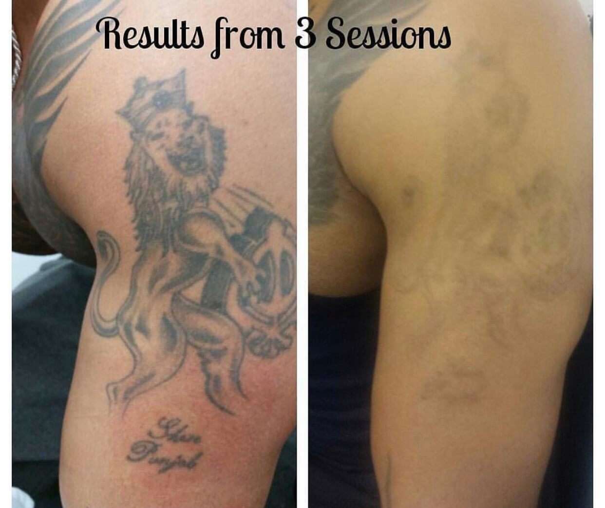 Tattoo Removal Coventry