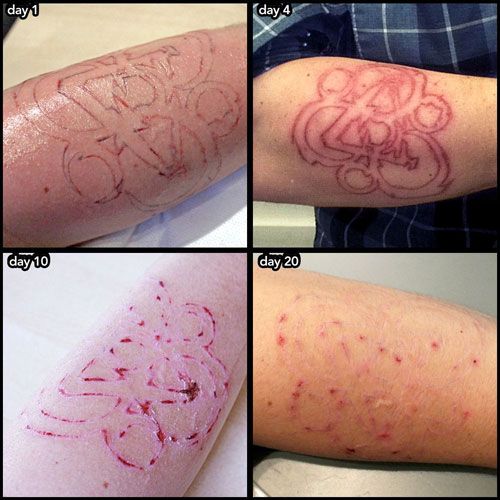 Tattoo Removal Cream Proces Wrecking Balm Tattoo Removal Cream