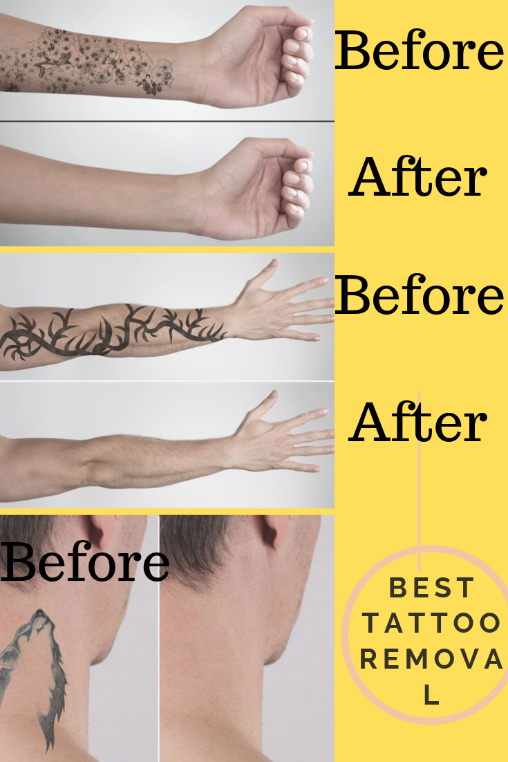 Tattoo Removal Cream Where To Buy