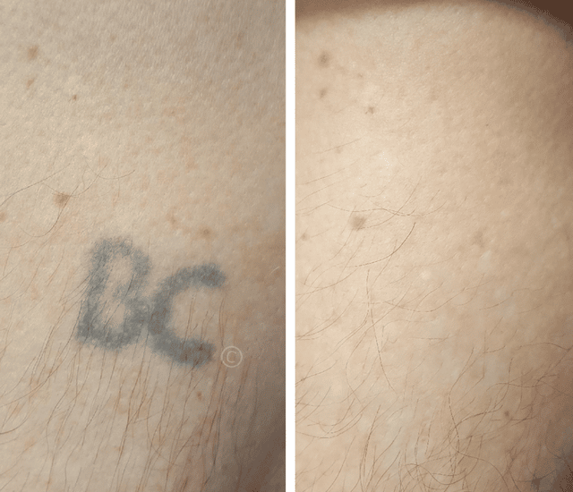 Tattoo Removal Experts