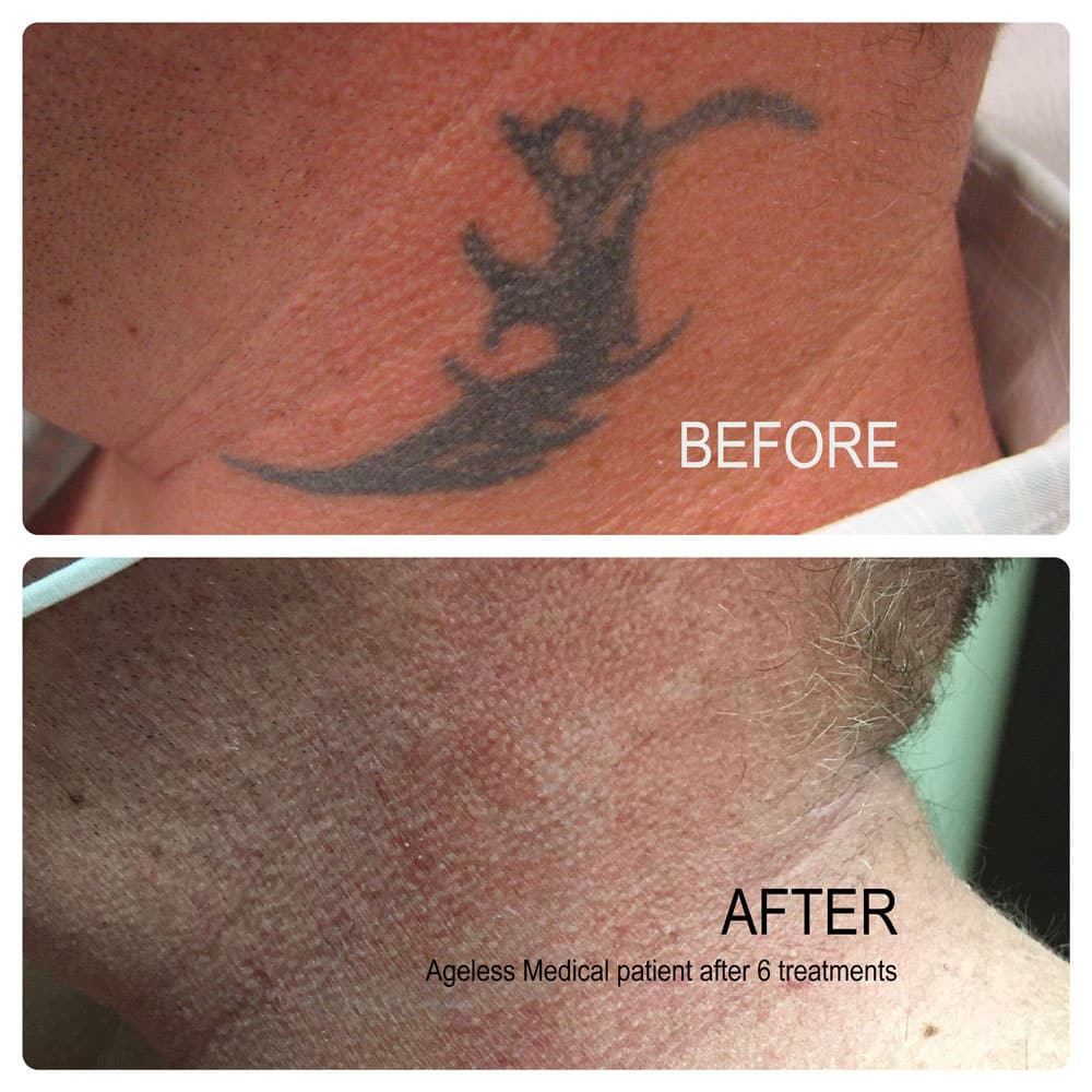 Tattoo Removal Fort Lauderdale