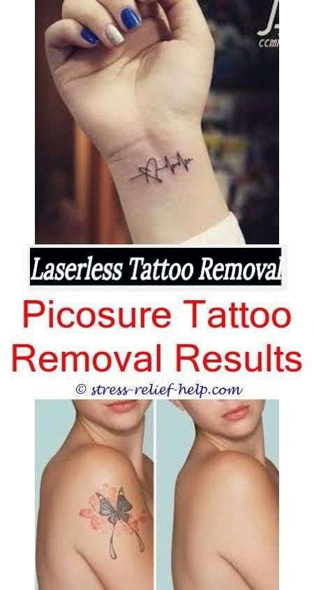 Tattoo removal franchise.How to treat laser tattoo removal ...
