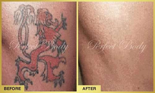 Tattoo Removal Gallery