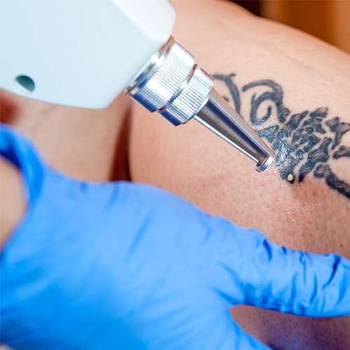 Tattoo Removal In Queens / Laser Tattoo Removal: How Long Does the ...