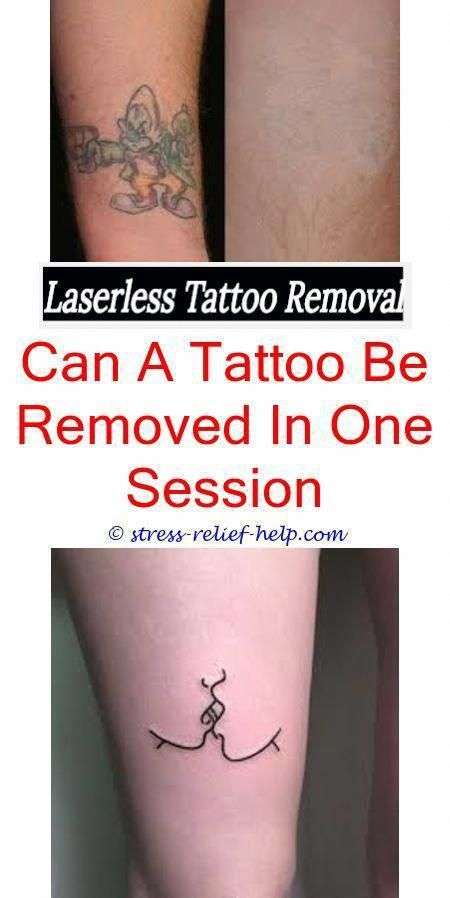 Tattoo Removal In Raleigh Nc