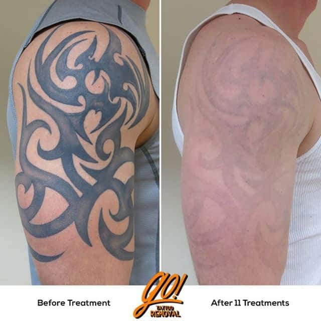 Tattoo removal is a slow long process. This client started with us 33 ...