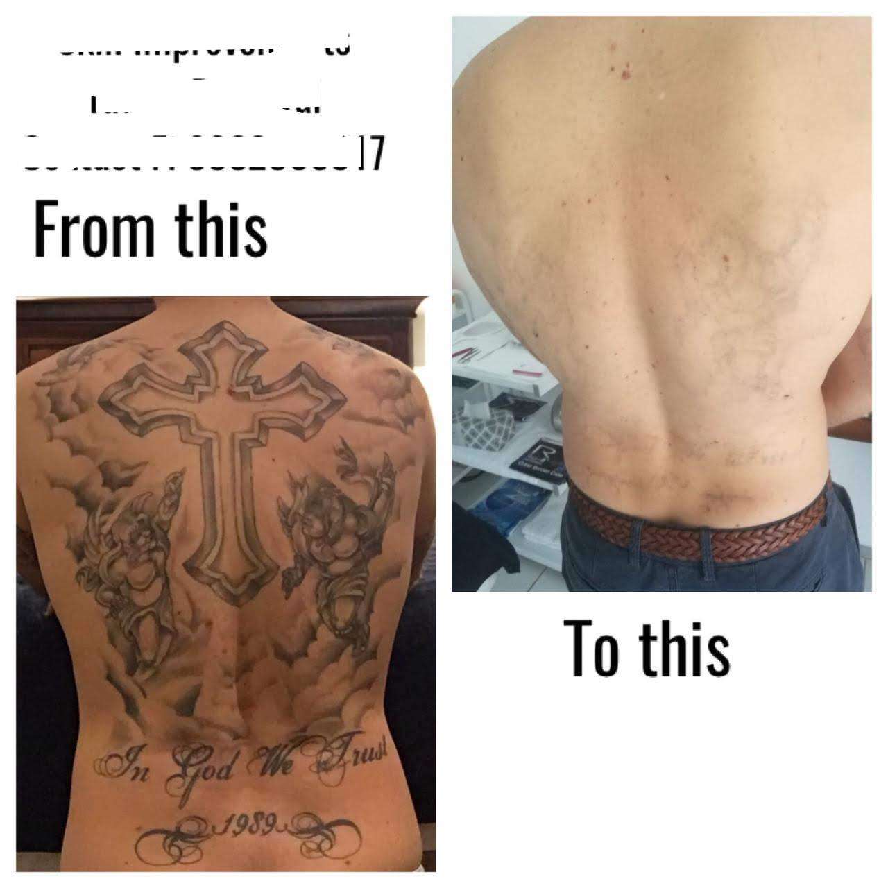 Tattoo Removal Itchy Reddit