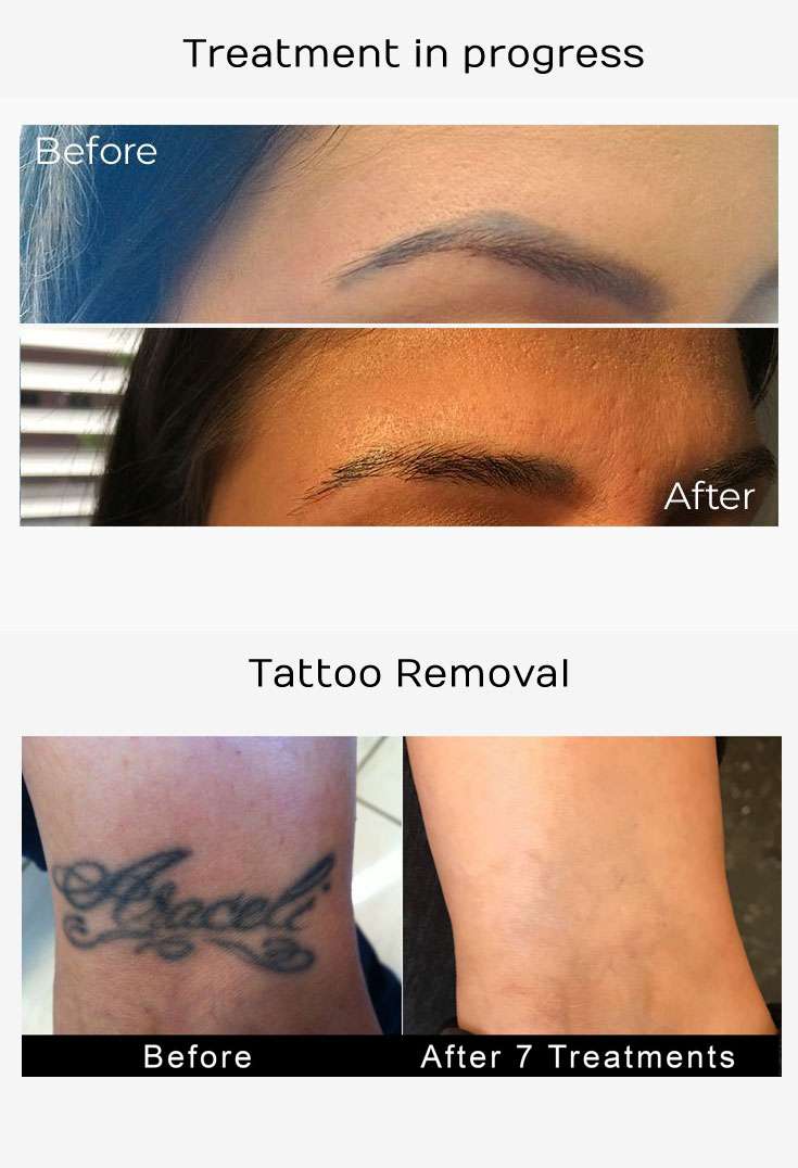Tattoo Removal Los Angeles