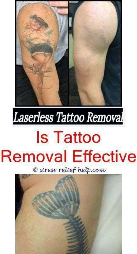 tattoo removal near me does laser completely remove tattoo