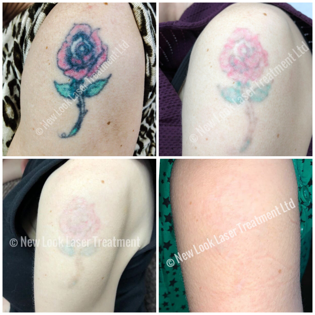 Tattoo Removal  New Look Laser Treatment Ltd