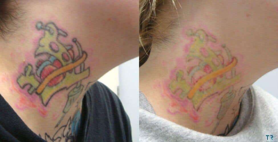 Tattoo Removal of Colours