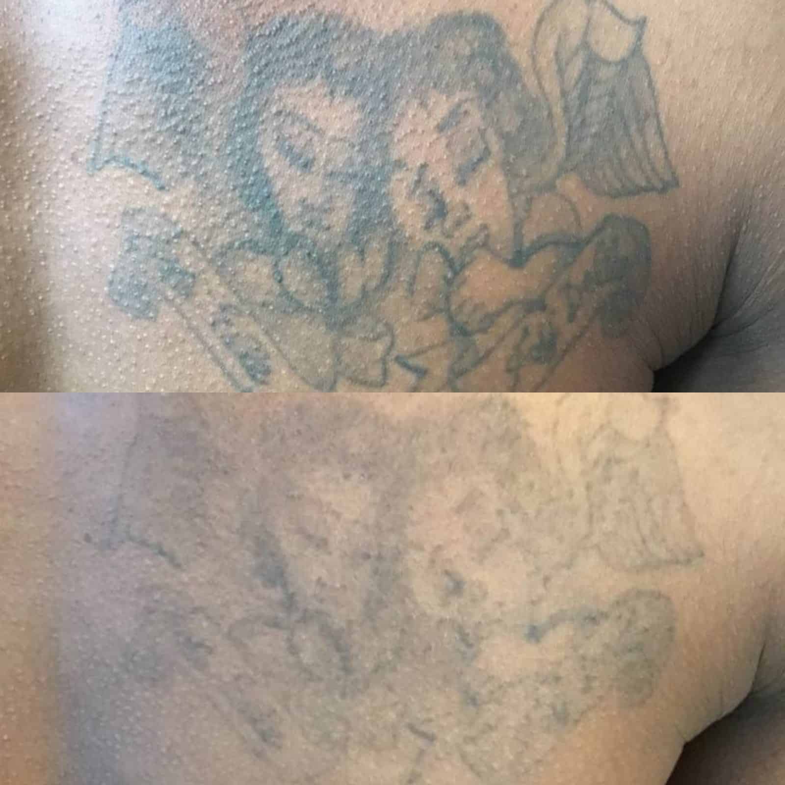Tattoo Removal on Black &  Asian Skin â¢ Lorena Oberg