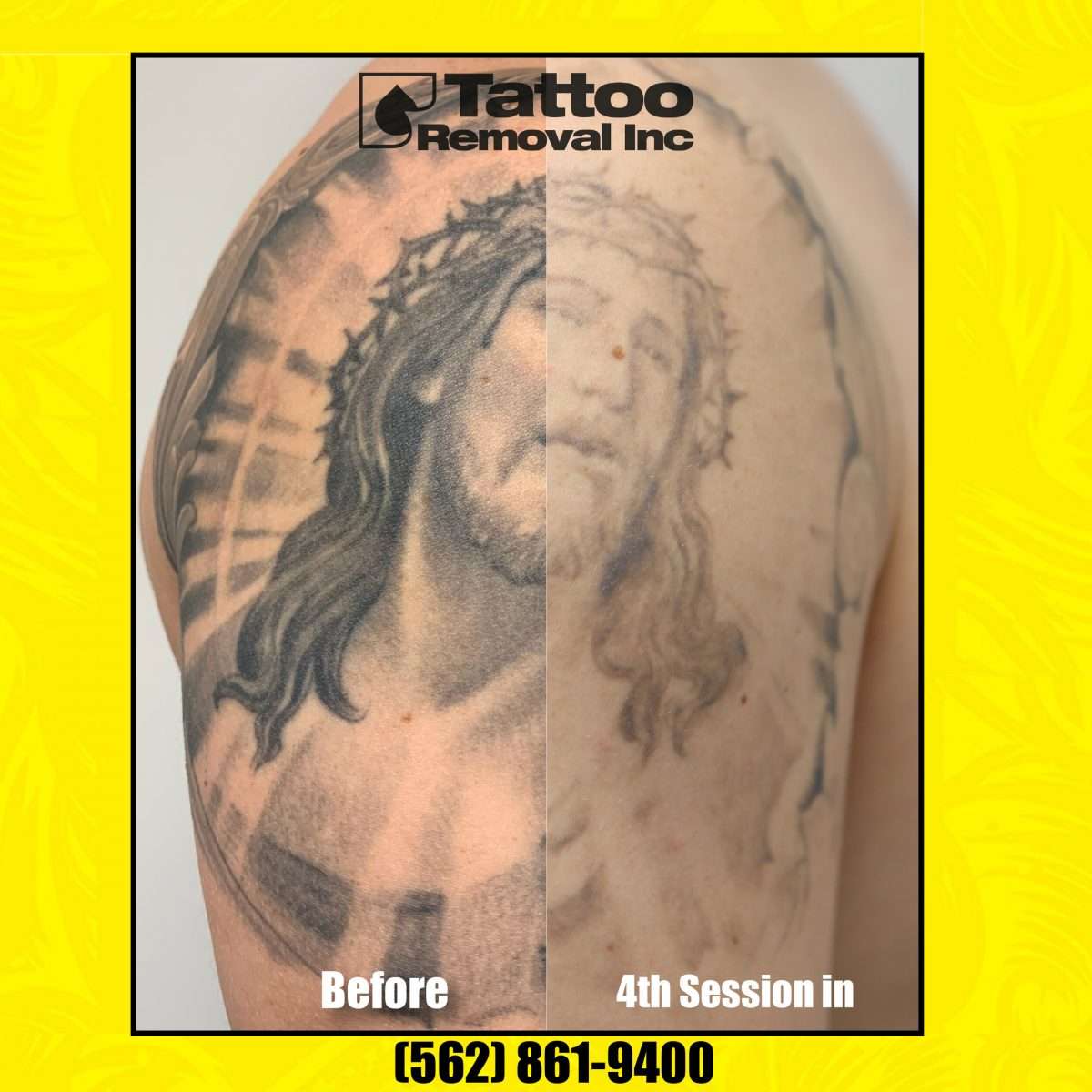 Tattoo Removal Orange County Ca