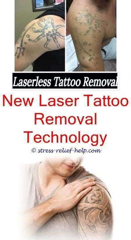Tattoo Removal Pregnant / Can you get a tattoo removed ...