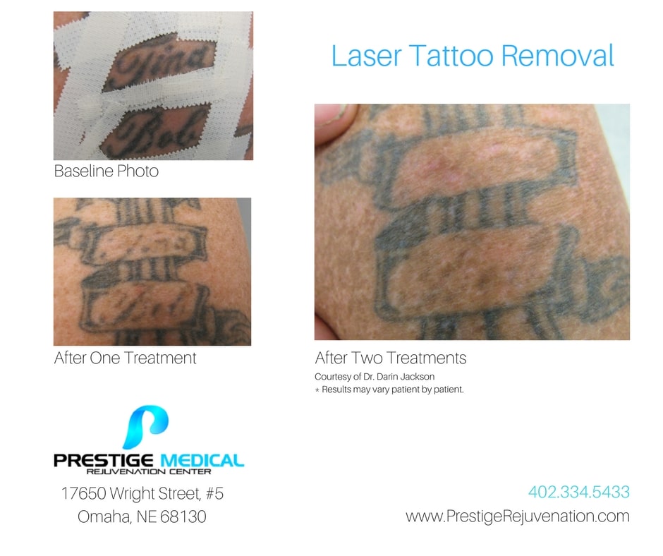 Tattoo Removal Price List from Prestige Laser Solutions
