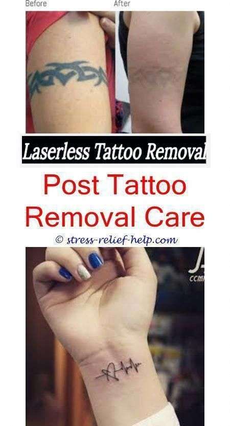 tattoo removal prices how does a tattoo get removed